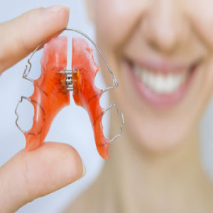 Why I Need To Wear Retainers after Braces? | Orthodontist Pasadena