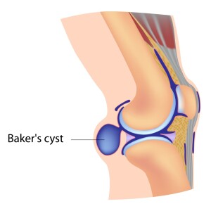 107: Knee Deep: Understanding Baker’s Cysts (with Whitney Lowe & Til Luchau)
