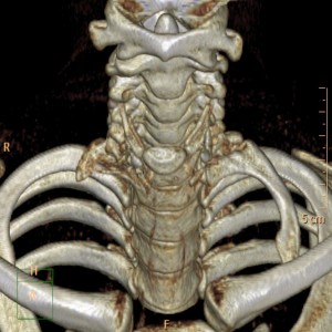 34: Thoracic Outlet Syndrome: What You Didn’t Know