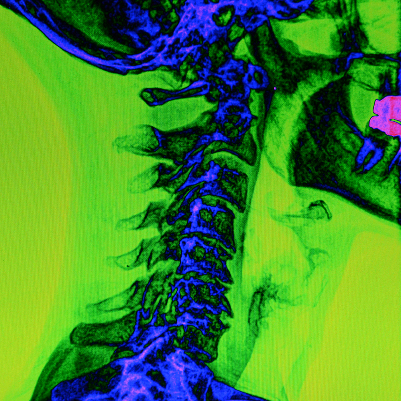 31: Headaches of Another Kind: Cervicogenic Heachaches