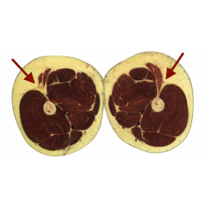 46: To ITB, or Not To ITB? (Iliotibial Band Controversies, Conditions, and Approaches)