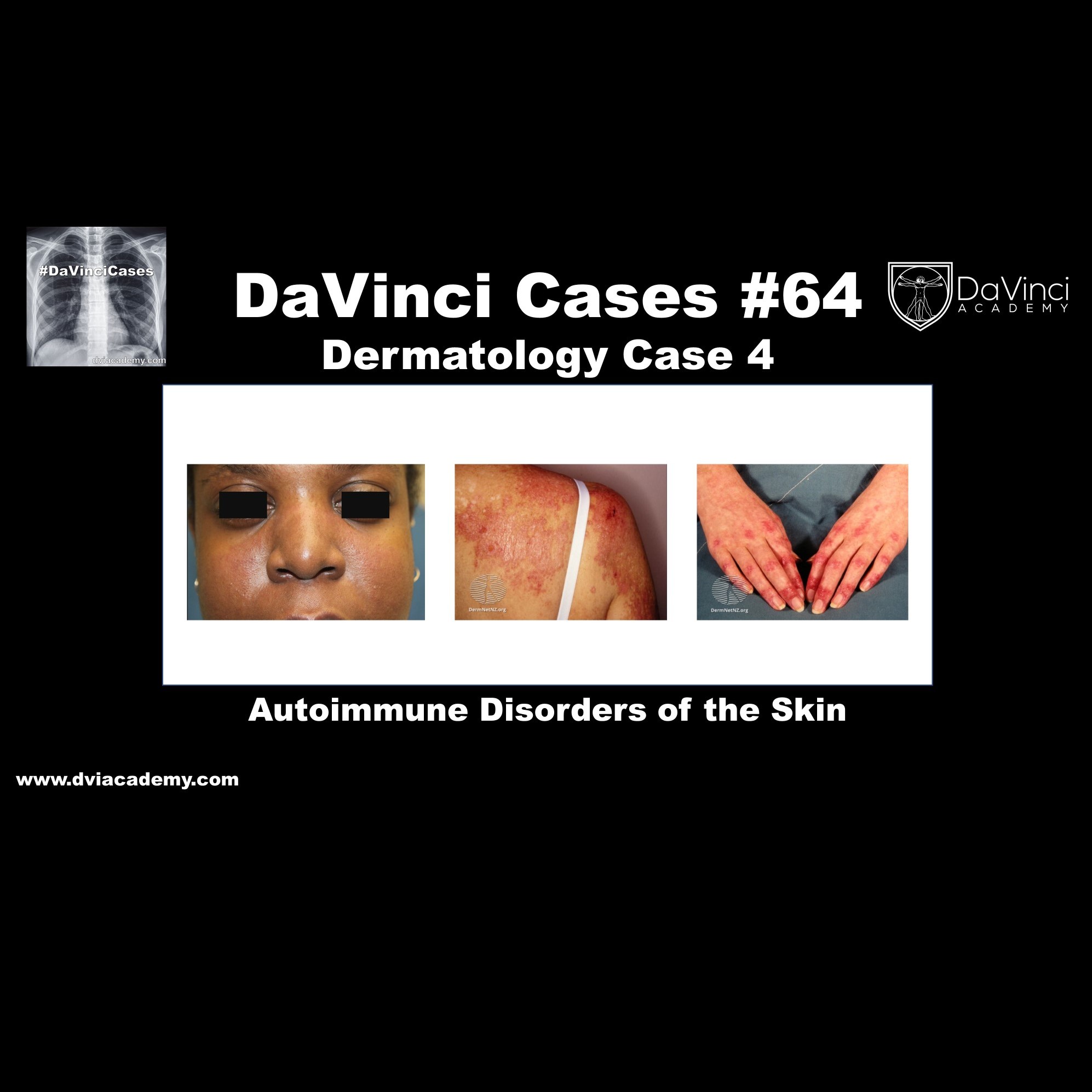 Autoimmune Disorders of the Skin [#DaVinciCases Dermatology Case 4]