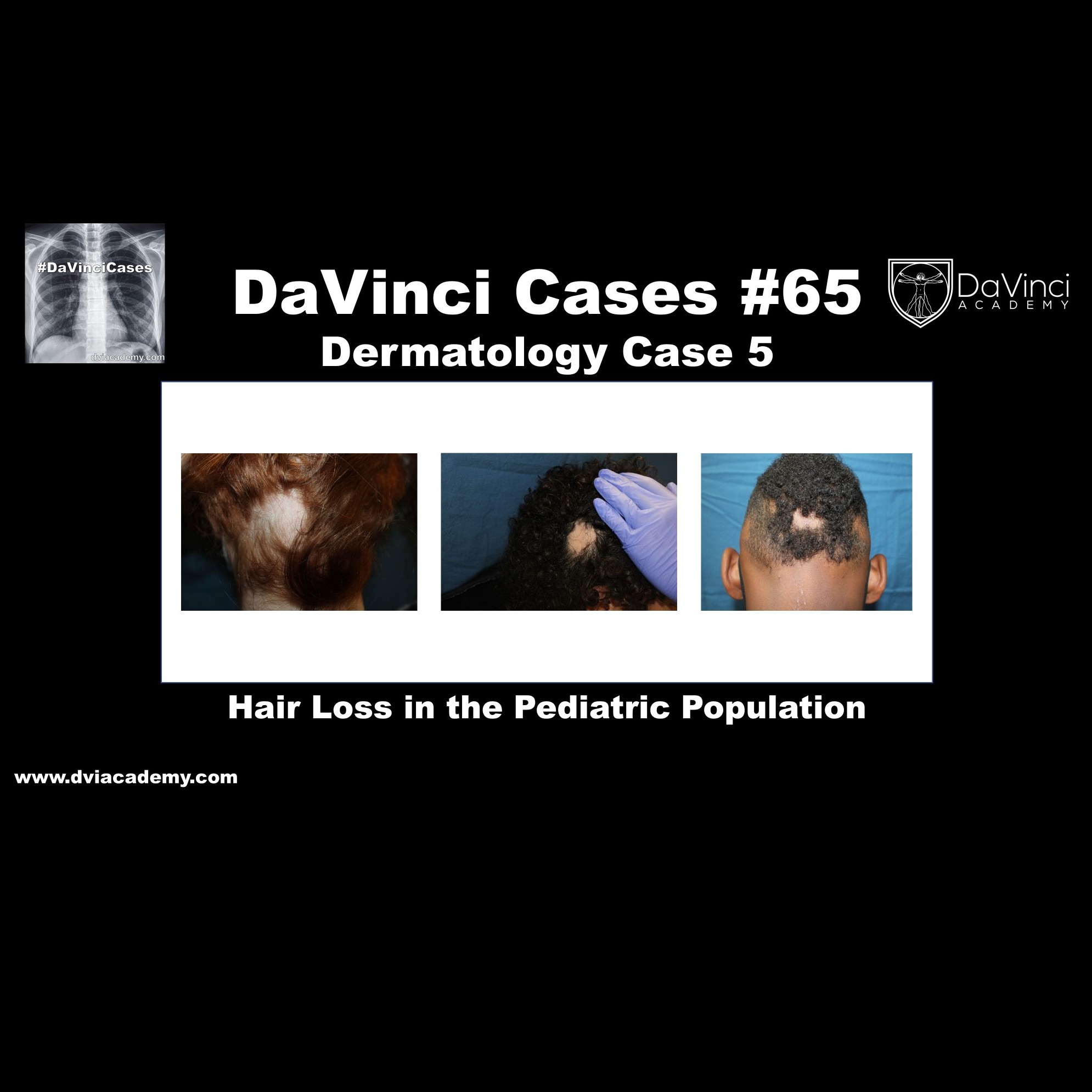 Hair Loss in the Pediatric Population  [#DaVinciCases Dermatology Case 5]