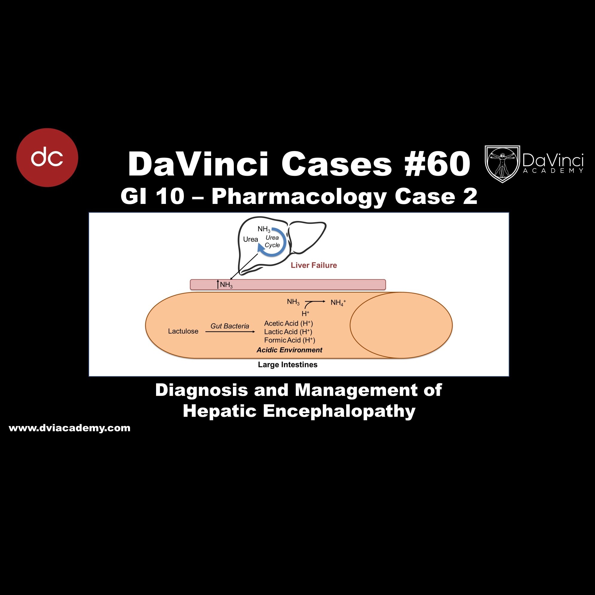 Diagnosis and Management of Hepatic Encephalopathy [#DaVinciCases GI 10 - Pharmacology Case 2]