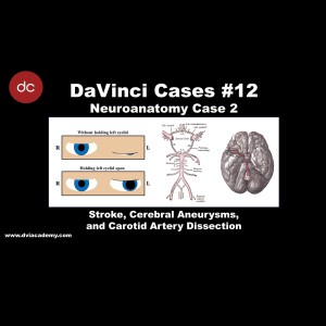 Stroke, Cerebral Aneurysms, and Carotid Artery Dissection [#DaVinciCases Neuroanatomy 2 - Cerebrovascular 2]