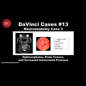 Hydrocephalus and Brain Tumors [#DaVinciCases Neuroanatomy 3 - Brain Lesions 1]