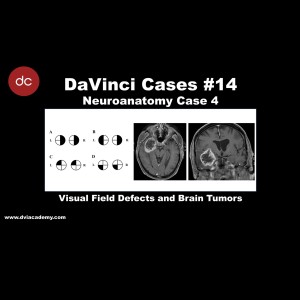 Visual Field Defects and Brain Tumors [#DaVinciCases - Neuroanatomy 4 - Brain Lesions 2]
