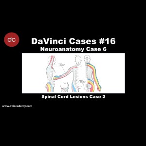 Spinal Cord Lesions 2 [#DaVinciCases - Neuroanatomy 6 - Spinal Cord Lesions Case 2]