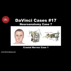 Cranial Nerves Lesions 1 [#DaVinciCases Neuroanatomy 7 - Cranial Nerves 1]