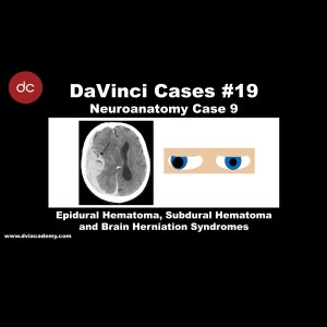 Epidural Hematoma, Subdural Hematoma, and Brain Herniation [#DaVinciCases Neuroanatomy 9 - Neurotrauma Case 1]
