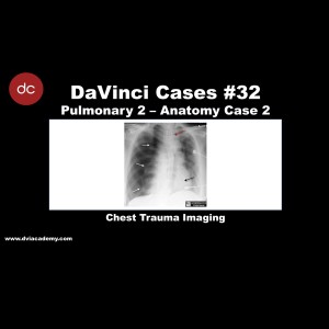 Chest Trauma Imaging [#DaVinciCases Pulmonary 2 - Anatomy Case 2]