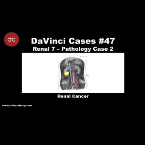 Renal Cancer [#DaVinciCases Renal 7 - Pathology Case 2]