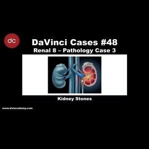 Kidney Stones [#DaVinciCases Renal 8 - Pathology Case 3]