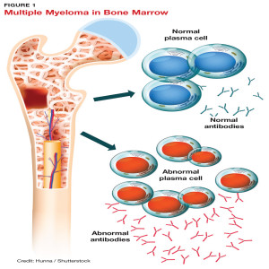 How long a person can live with multiple myeloma?