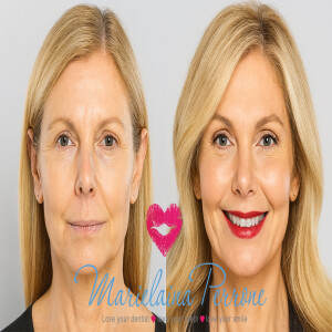 Could a “Liquid Facelift in Henderson, NV” Be Right For You?