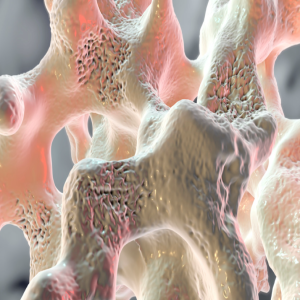 Osteoporosis for GPs