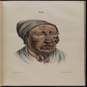 The Plague of Leprosy