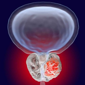 Early detection of prostate cancer