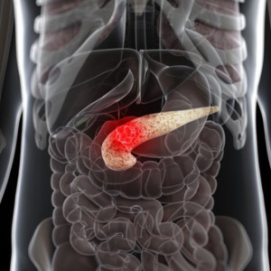EP 02 Pancreatic cancer (signs&symptoms)