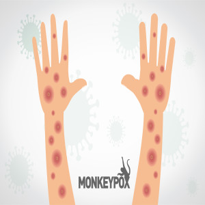 Monkeypox???! ＞＞＞ What You Need to Know