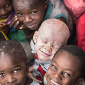 Journée internationale de sensibilisation à l'albinisme