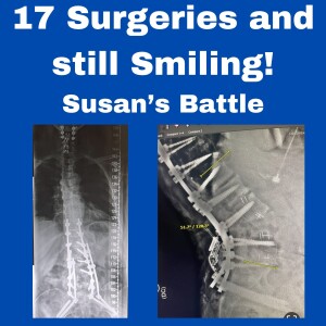 17 Surgeries and Still Smiling: Susan's Inspiring Battle with Scoliosis