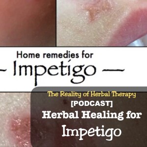 Herbal Healing for Impetigo