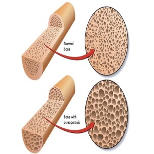 Sodium Restriction Causes Bone Loss (Osteoporosis)