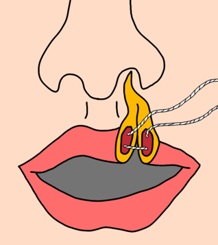 Case 8 - Paediatric laceration - Soft tissue