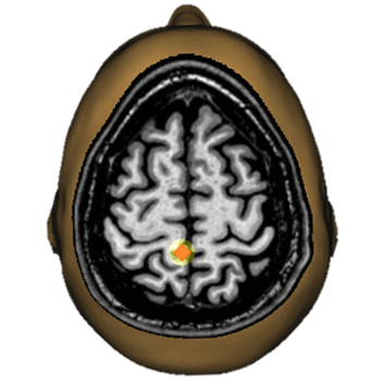 Multiple Sclerosis and Reduced Somatosensory Gating