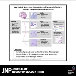 Case Studies in Neuroscience: Neuropathology and diaphragm dysfunction in ventilatory failure from late-onset Pompe disease