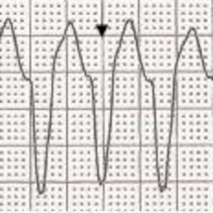 Ventricular Arrhythmias, Escape Rhythms, Artifact